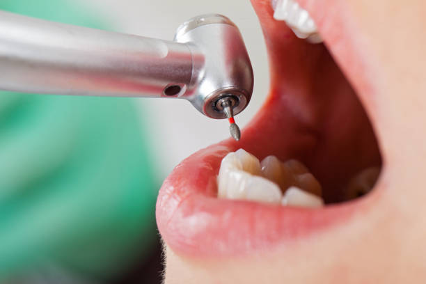 Best Dental Abscess Treatment in Clovis, NM
